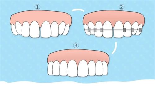 35歲矯正牙齒：後悔是否晚了？避免後悔的關鍵在這裏！