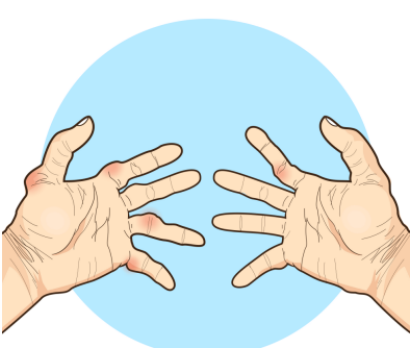 得了類風濕關節晨僵用什麽藥緩解？如何緩解晨僵的症狀？