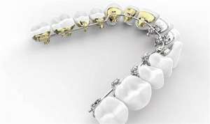 石家莊牙齒矯正得多少錢？傳統金屬矯正7800+隐形矯正25000+舌側矯正50000+