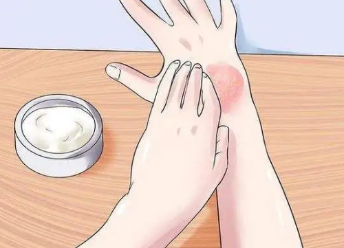 小兒牛皮癬的典型症狀有哪些