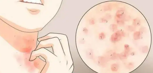 皮膚病中的神經性皮炎和濕疹你知道怎麽區分嗎