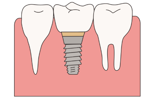 上海種植牙後吃什麽