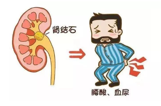 杭州患上腎結石治療方法怎麽選口碑排石專業醫院！
