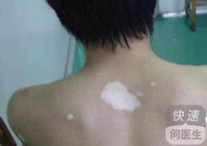 白癜風病因 白癜風是怎麽引起的