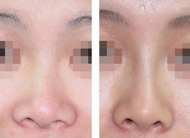 重慶最好隆鼻手術醫院