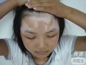 面部白癜風症狀鑒别診斷學