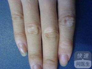 先天性白癜風能治愈嗎 怎樣預防白癜風