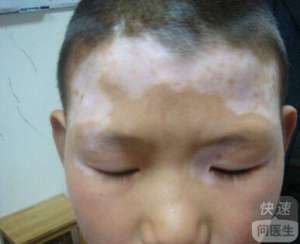 15歲孩子臉上長白癜風是什麽原因