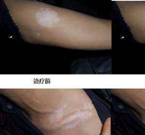 手臂上有小白點是白癜風嗎