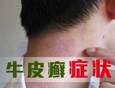 病發初期的牛皮癬症狀