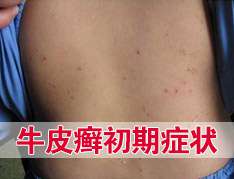 尋常型牛皮癬的症狀特點是什麽呢