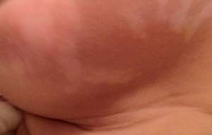 兒童白癜風怎樣治療