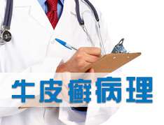 牛皮癬的病因一般有哪些