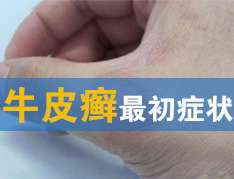 牛皮癬初期症狀有哪些？