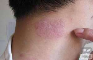 牛皮癬患者應該做哪些檢查 牛皮癬的常規檢查方式