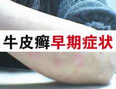 不同人群的牛皮癬的症狀表現