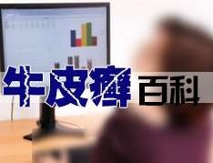 兒童牛皮癬怎麽用藥