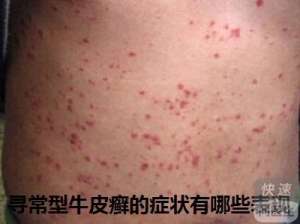 尋常型牛皮癬不同時期的症狀