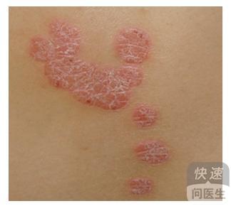 得了牛皮癬該如何有效治療  你知道嗎