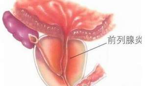男性怎樣治前列腺炎好