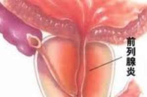 男性患了前列腺炎怎麽辦