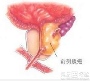 秋冬季是前列腺疾病高發期