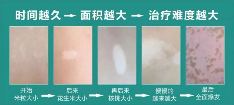 煙台白癜風興趙毅解答白斑患者穿衣要注意的問題