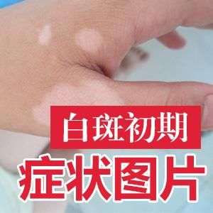 手部作爲白癜風高發區，都是受哪些因素影響的