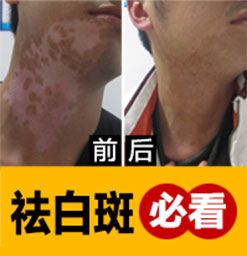 洛陽重點白癜風醫院講怎麽看白斑有沒有好轉