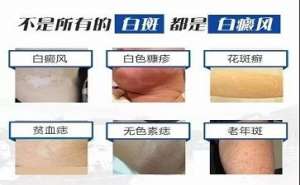 白癜風醫生袁仁軍詳談白癜風是不是傳染病