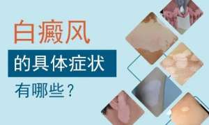 白癜風能吃雞蛋嗎 白癜風期間的飲食注意事項
