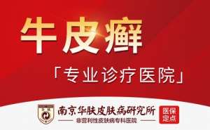 牛皮癬的早期症狀有哪些？南京治療牛皮癬好的醫院